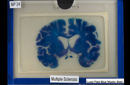 Luxo fast blue myelin stain of brain thin section illustration anatomical effects of multiple sclerosis.